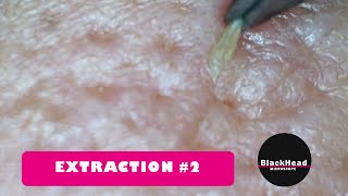 Whitehead and BlackHead RemovalExtraction 2 Reedition [upl. by Pulsifer667]