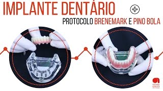 Implante dentario e dentadura prótese dental [upl. by Dixil927]