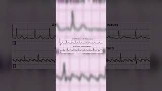 Atrial fibrillation vs Atrial flutter  Medicos  Cardiology [upl. by Nnylyahs]