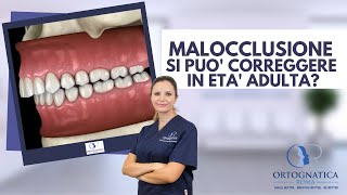 Malocclusioni dentoscheletriche è possibile correggerle in età adulta [upl. by Notlok]