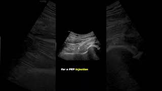 ultrasound Guided Interventions Cases Hip Joint PRP Injection [upl. by Margaret885]