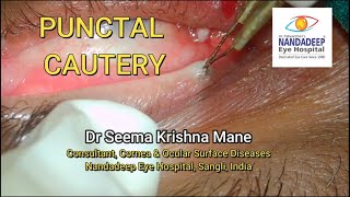 How to do Punctal cautery  Dr Seema Mane Indications and procedure [upl. by Gnouc]