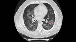 Centrilobular pathology on high resolution chest CT HRCT [upl. by Ailed]