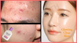 How to Get Rid of Pimples Acne Skin Rashes Prickly Heat Overnight  Lacto Calamine Benefits [upl. by Durarte169]