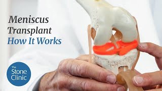 Meniscus Replacement  How it Works amp What to Expect [upl. by Russom]