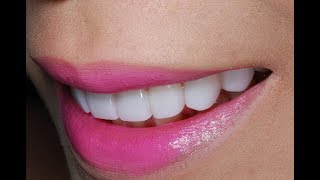 Video of Dental Veneers Procedure To a Young Patient at Cosmetic Dental Associates [upl. by Leiruh]