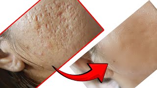 How To Get Rid of Acne Scars✅ [upl. by Airahs896]