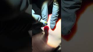 The Electrolysis Expert Permanent Haier Removal Session [upl. by Aniad]