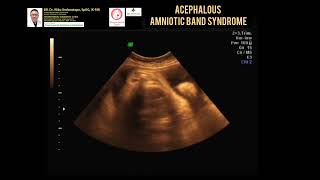 Acephalous  Amniotic band syndrom [upl. by Giulietta598]