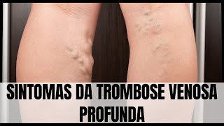 Sintomas da Trombose Venosa Profunda [upl. by Rubio406]