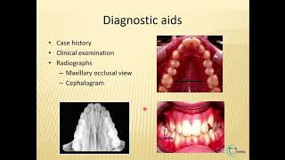 Arch expansion in orthodontics part 1 made easy  Orthodontics  Dentophile [upl. by Eetsirhc]