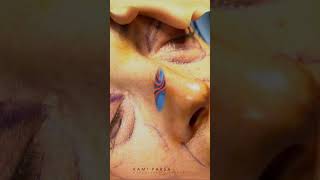 How Its Done Upper and Lower Eyelid Surgery with Dr Kami Parsa [upl. by Ahsoyem]