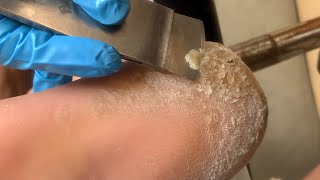 Callus removal from feetampFoot scraping dead skin【Xiao Yan pedicure】stress 1112 [upl. by Gothart]