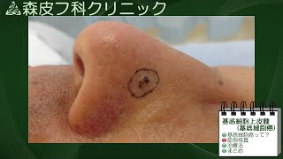 動画による皮膚病の解説 第９回 【基底細胞癌】 [upl. by Elle]