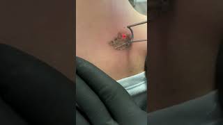 aparat laser indepartare tatuaje [upl. by Ittap]