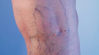 The Basics Varicose Veins  WebMD [upl. by Nauwaj]