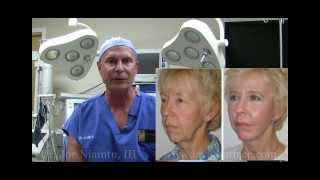 The Truth About Facelift Surgery Part 1 by Dr Joe Niamtu III [upl. by Zirtaeb]