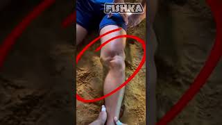 Dislocation of the knee joint shorts [upl. by Issie]