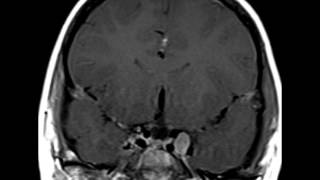 Neurofibromatosis Type 2 [upl. by Kissiah]