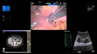 BK Medical Robotic Assisted Partial Nephrectomy RAPN by Dr James R Porter [upl. by Wilone808]