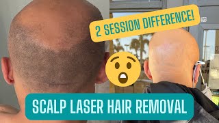 LASER HAIR REMOVAL ON SCALP  CANDELA GENTLEMAX PRO [upl. by Hirst250]