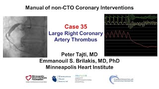 Case 35 PCI Manual Large RCA thrombus [upl. by Hailed588]