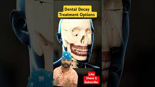 Dental Cavity treatment Optionsyt ytshorts shorts dental ytshortsindia teethdentalcavity [upl. by Suhpesoj]