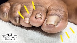 How to Fix Toenail Discomfort [upl. by Anetsirk]