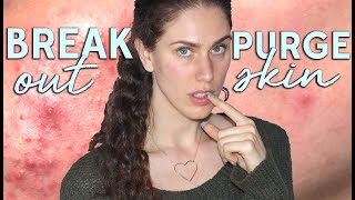 Skin Purge VS Breakouts  How To Tell If Youre Having A Product Reaction [upl. by Butta402]