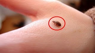 How to Treat Bed Bug Bites Naturally [upl. by Velleman]