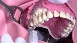 Periodontal surgery Modified Widmann flap [upl. by Atiniuq]