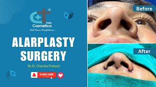 Alarplasty before and after [upl. by Ayatan]