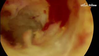 Hysteroscopic Adhesiolysis  Dr B Ramesh [upl. by Eindys]