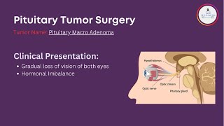 Endoscopic Pituitary Tumor Surgery [upl. by Ahsataj]