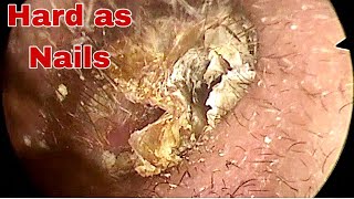 Hard as Nails Earwax Removal  Doctor Anh [upl. by Aivatnahs]