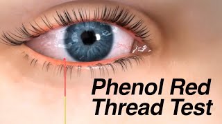 Phenol Red Thread Test for Dry Eyes [upl. by Akimrej]