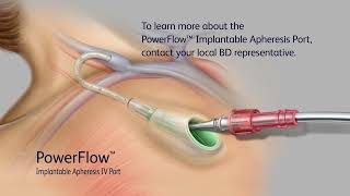 PowerFlow Implantable Apheresis IV Port Access Video [upl. by Aerdnua]