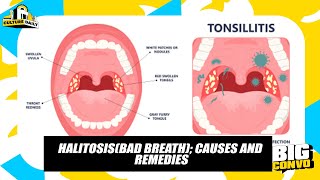 Halitosis Causes Effects And It’s Treatment [upl. by Liahcim]