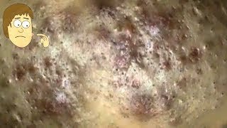 Clam Removal Blackheads On The Face Acne  How To Remove Blackheads Easy [upl. by Ahsemik]