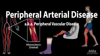 Peripheral artery disease Pathophysiology Causes Symptoms Diagnosis and Treatments Animation [upl. by Odrareve706]