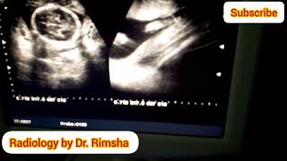 Anterior placenta and baby boyGender prediction on ultrasound Baby boy on ultrasound [upl. by Velvet]