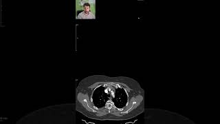 PAIN and MISSING PULSE in the left arm  CT SCANS Ep 15 ctscan medicalimaging angiography [upl. by Norbie]