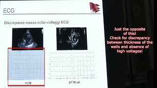 AMILOIDOSI CARDIACA ESSENTIALS OF CARDIAC AMYLOIDOSIS [upl. by Enelrihs]