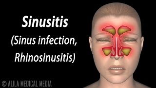 Sinusitis Animation [upl. by Natsreik421]