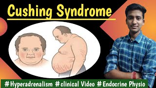 Cushing Syndrome Hyperadrenalism Endocrine Physiology LecturesMBBS Ashish [upl. by Okimuy133]