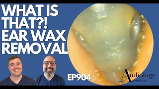 WHAT IS THAT EAR WAX REMOVAL  EP904 [upl. by Oitaroh]