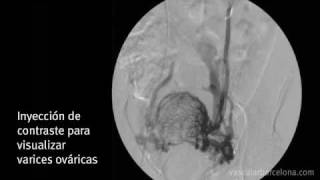 Tratamiento síndrome congestivo pélvico · VASCULAR Barcelona [upl. by Ahsenauj]