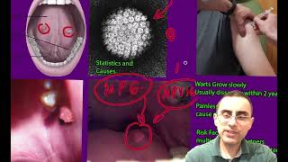 Oral Warts Explained Causes Symptoms and Treatments [upl. by Llerej112]