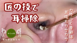 【耳かき】匠の技とベビー綿棒で耳掃除 【ear cleaning】 [upl. by Horvitz]