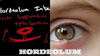 Hordeolum  hordeolum internum  hordeolum externumStye [upl. by Ecydnarb535]